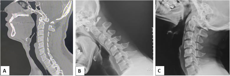 Sagittal CT of an unfused odontoid plus flexion and extension laterals showing C1-C2 instability