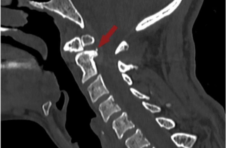 Sagittal CT of a dystopic os odontoideum with posterior atlantoaxial subluxation