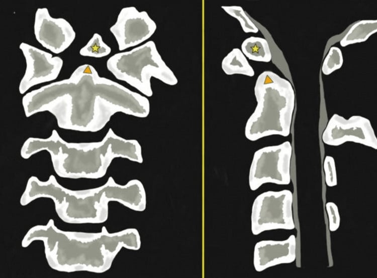 Anteroposterior and lateral diagrams of an oval os odontoideum with a hypoplastic odontoid process