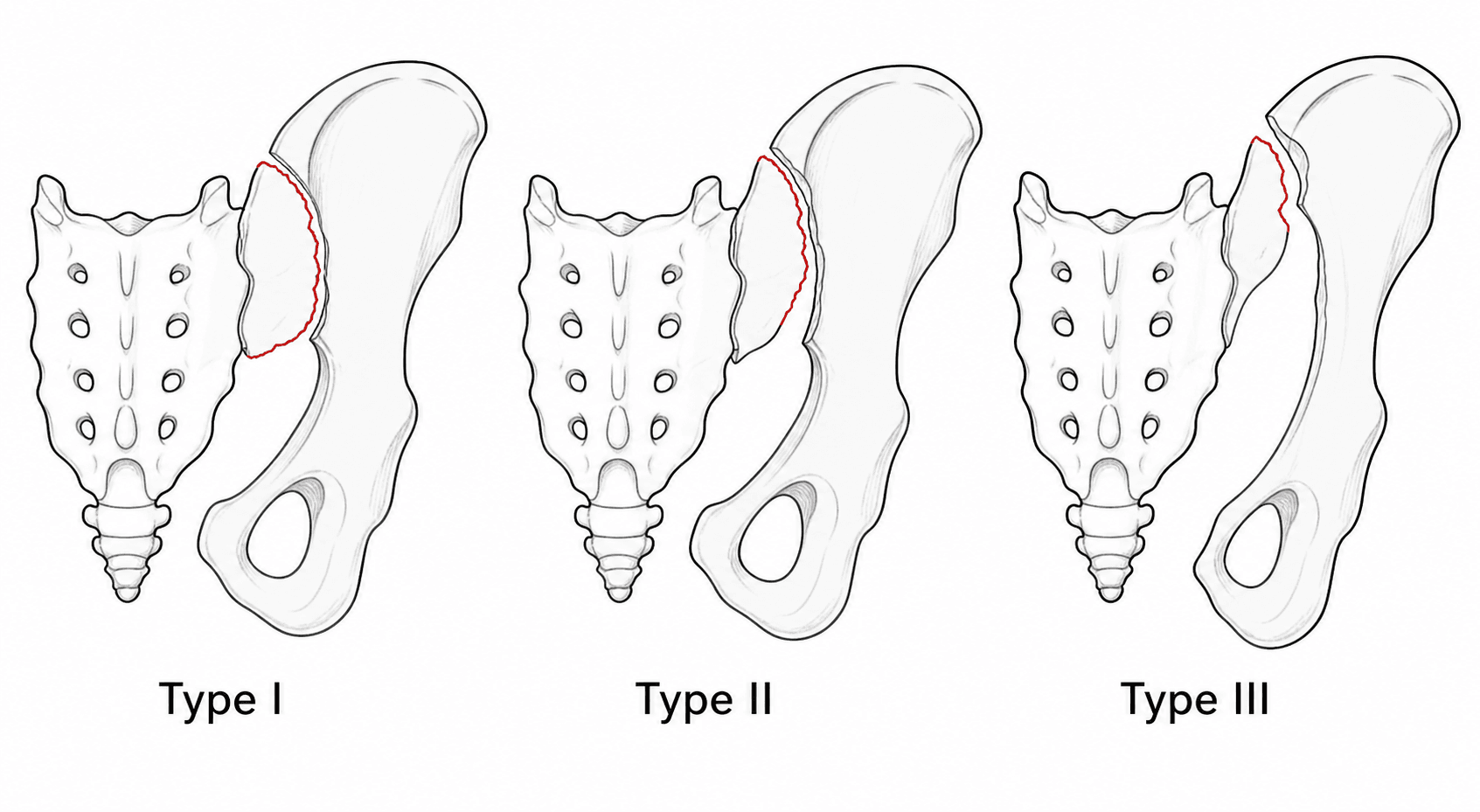 Three-panel diagram of the Day classification of crescent fracture showing large, intermediate and small crescent fragments