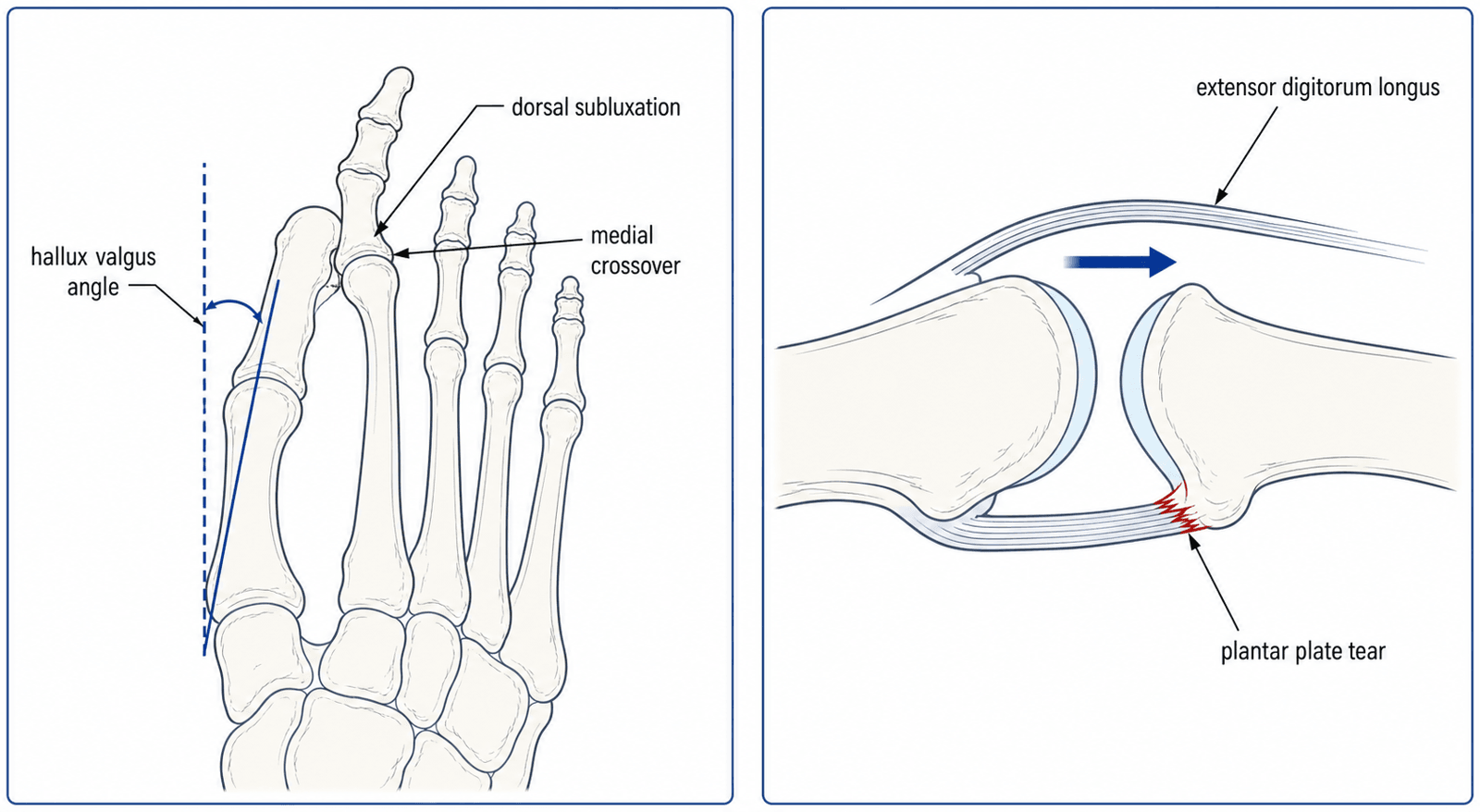 Two-panel schematic of crossover second toe: dorsal forefoot line diagram showing hallux valgus angle and second-toe dorsal/medial crossover, plus a sagittal schematic of the second MTP joint showing the plantar plate tear at its insertion on the proximal phalanx base with EDL overpull.