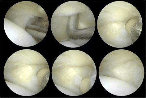 Six arthroscopic frames with a probe and instruments in a small grade I plantar plate tear