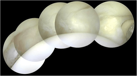 Panoramic montage of overlapping arthroscopic views of a lesser metatarsophalangeal joint