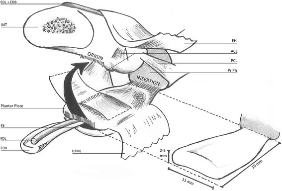 Labelled drawing of a lesser MTP joint with the plantar plate, its origin and insertion, the collateral ligaments, the flexor tendons and the plate's printed dimensions