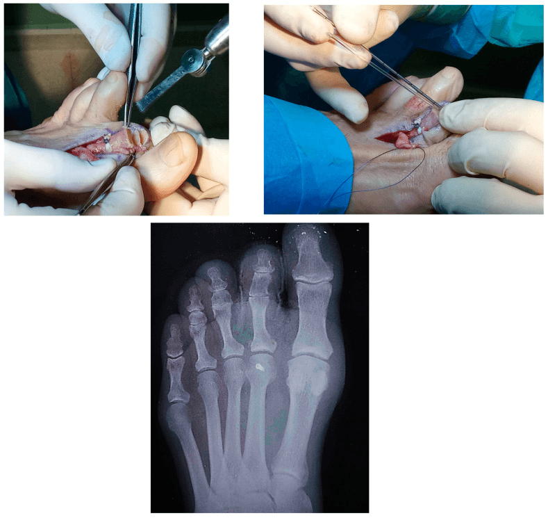 Two intra-operative photographs of PIP joint arthrodesis above a postoperative AP forefoot radiograph