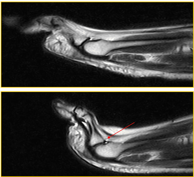 Neutral and extended long-axis MRI of a clinically unstable lesser MTP joint in which the stress study was falsely negative