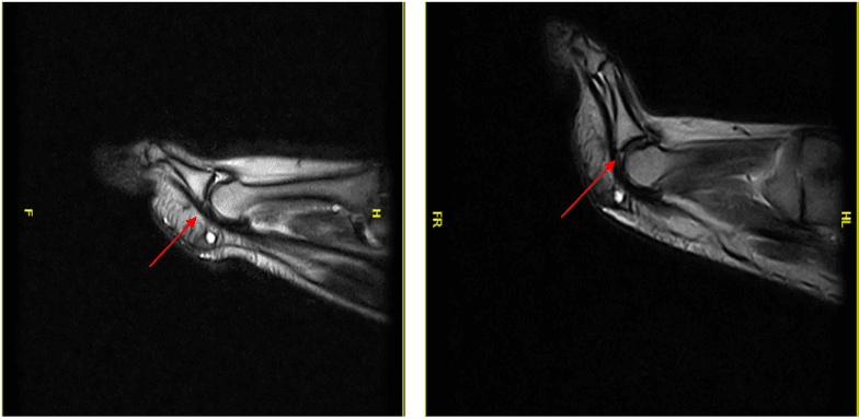 Paired long-axis MRI images of a toe, straight and extended, with a red arrow at the plantar MTP joint in each