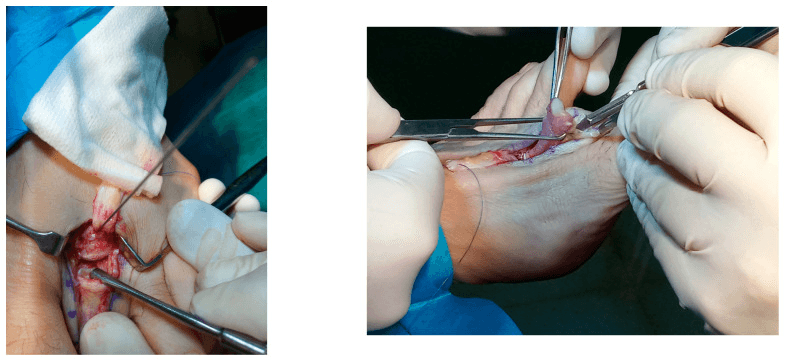 Weil osteotomy fixation and the flexor digitorum longus tendon lifted on instruments