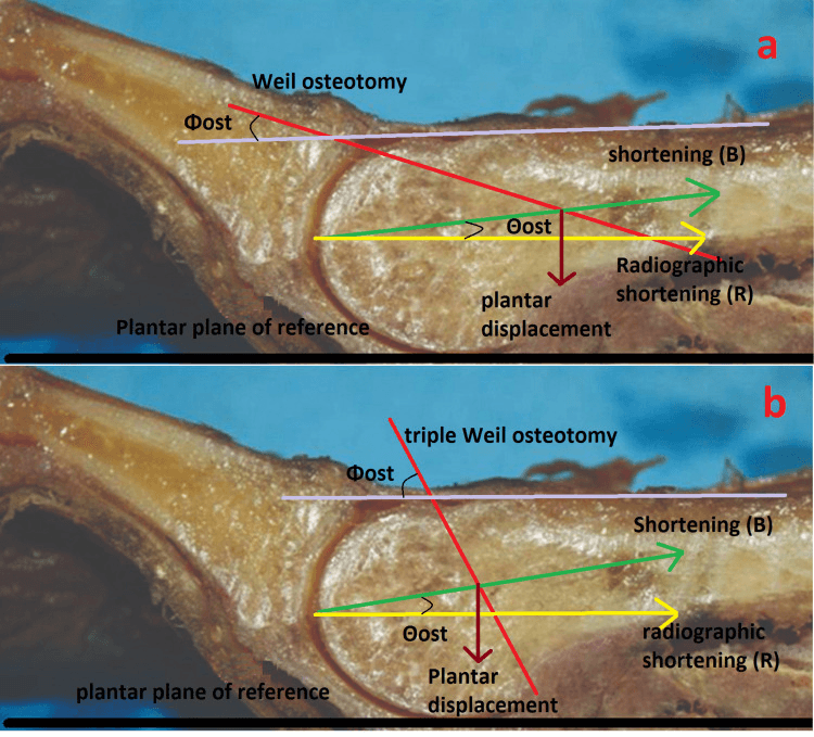 Cadaveric metatarsal head sections marking the osteotomy angles, shortening and plantar displacement of a Weil (a) and a triple Weil (b) osteotomy