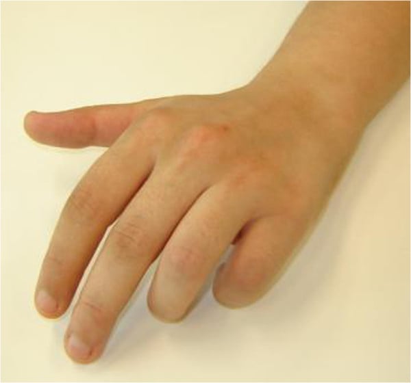 Dorsal photograph of a hand with flexion contracture of the ring and little fingers and dorsal swelling in partial CRPS type 1.