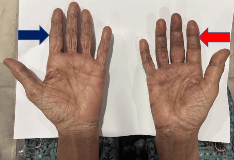Side-by-side palms showing CRPS-related oedema and colour asymmetry of the affected hand