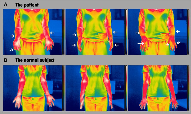 Serial infrared thermograms comparing lower arm temperature in CRPS type 1 with an asymptomatic control