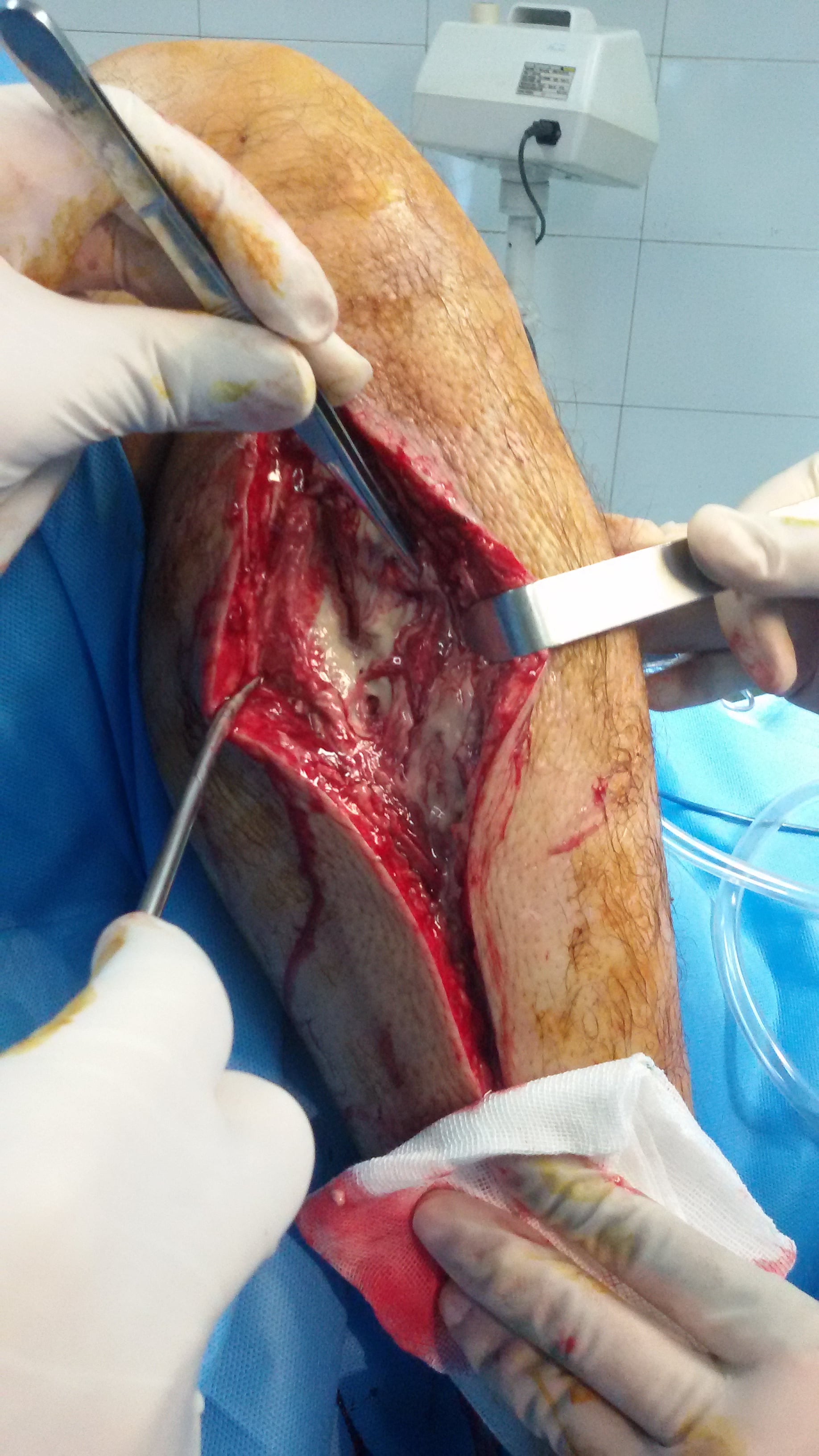 Operative photograph showing a lower-limb fasciotomy incision with the muscle compartments exposed.