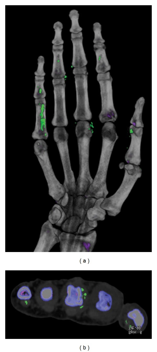 Dual-energy CT of hand showing monosodium urate crystal deposits