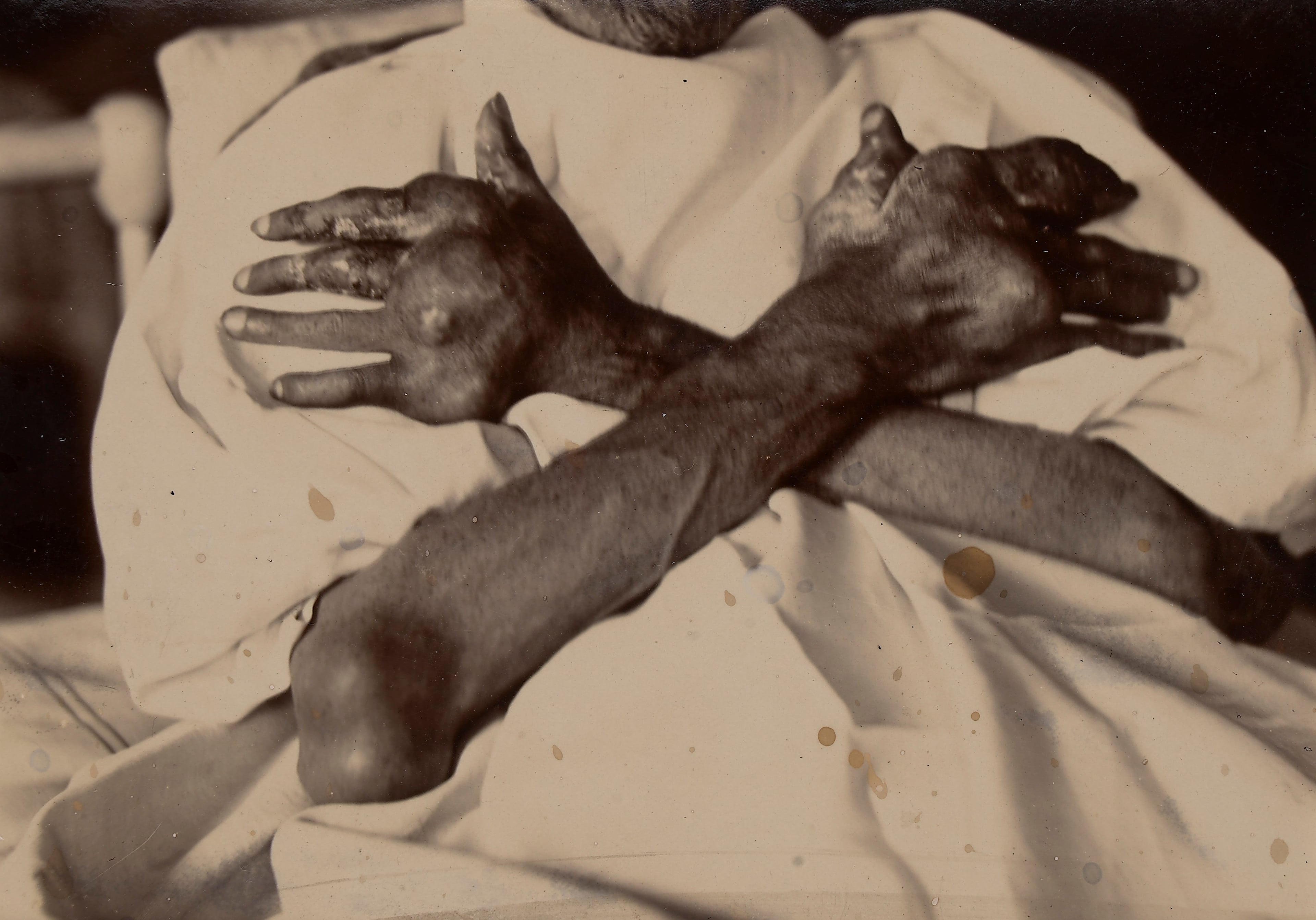 Clinical photograph showing bilateral forearms and hands with extensive tophaceous gout deposits