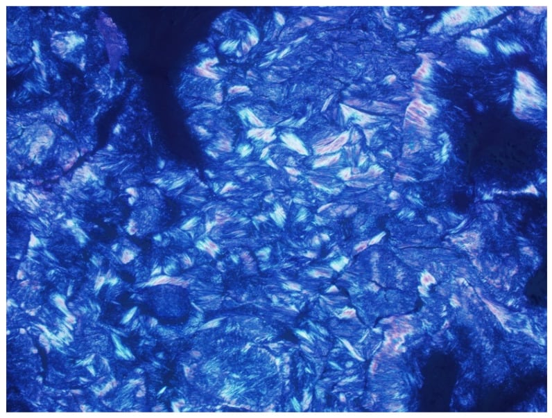 Polarized microscopy showing needle-shaped monosodium urate crystals with negative birefringence