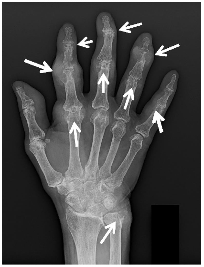 PA radiograph of right hand showing gouty arthropathy with characteristic erosions