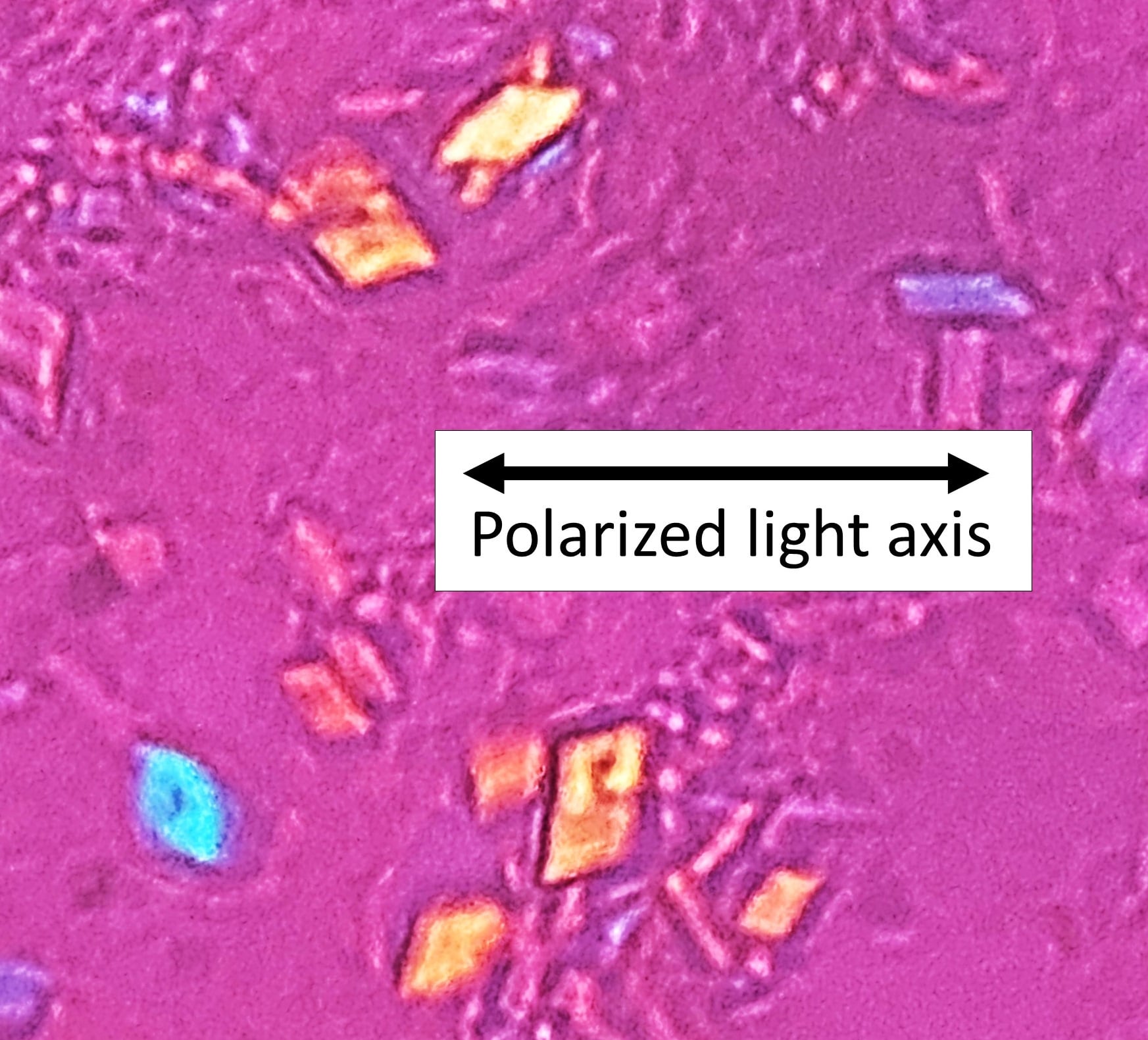 Compensated polarized light microscopy showing rhomboid-shaped calcium pyrophosphate crystals with weak positive birefringence, annotated with the polarized light axis.