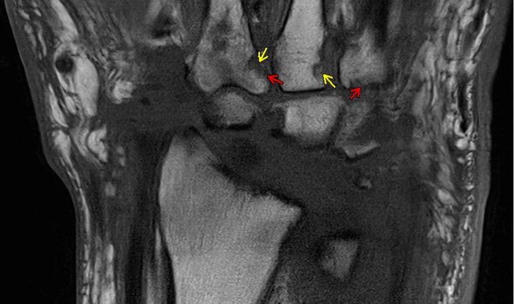 Coronal MRI of the wrist during a CPPD flare, yellow and red arrows marking erosive change at the carpal articular margins