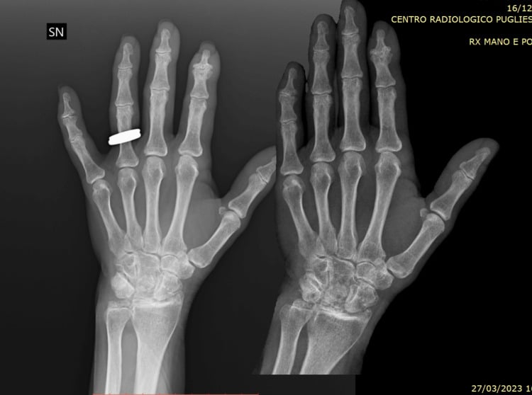 Serial hand and wrist radiographs in chronic CPPD, taken on different dates, compared for carpal erosions and geodes