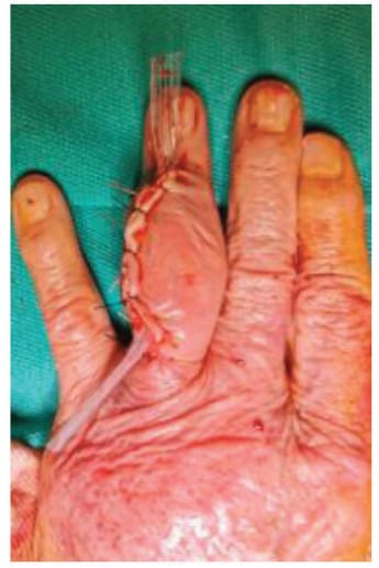 Dorsal view of a finger after excision of a giant tophaceous mass, the incision closed with sutures around a drain