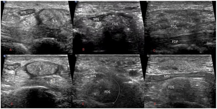 Carpal tunnel ultrasound in gout, six labelled panels (A-F) showing the median nerve, transverse carpal ligament and flexor tendons