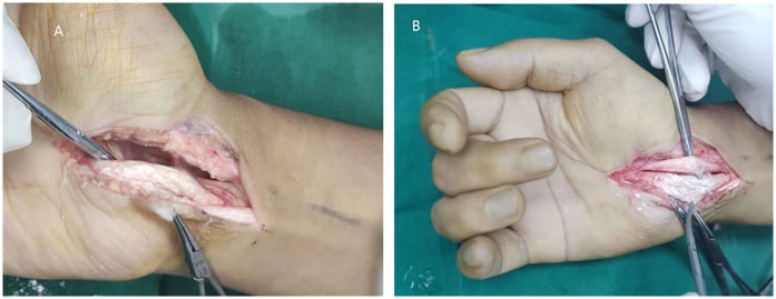 Open carpal tunnel decompression in gout, two panels showing chalky white tophaceous material in the opened flexor compartment