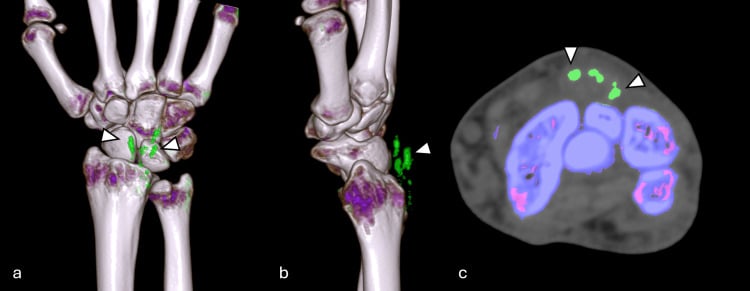 Dual-energy CT, two three-dimensional reconstructions and an axial image, showing green-coded urate deposits in the soft tissues of the wrist