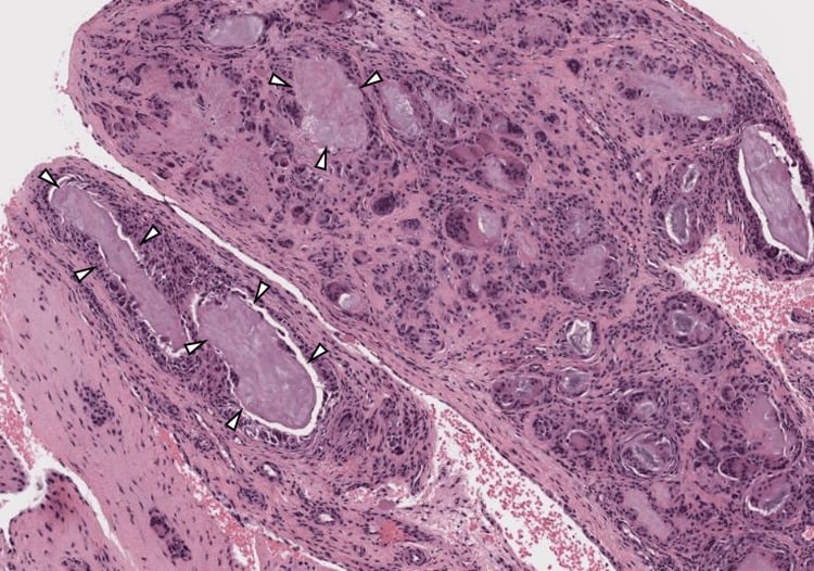 H&E histology of synovium containing a gouty tophus, arrowheads marking pale urate deposits bordered by giant cells