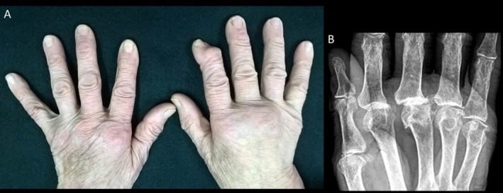 Hand osteoarthritis: nodal swelling of the finger joints of both hands (A) and a radiograph of the MCP joints (B)