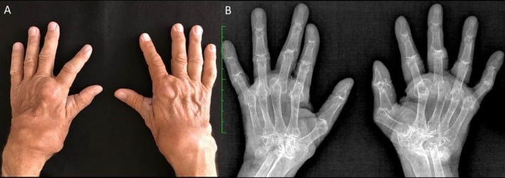 Both hands clinically (A) and bilateral hand radiographs (B) in long-standing rheumatoid arthritis
