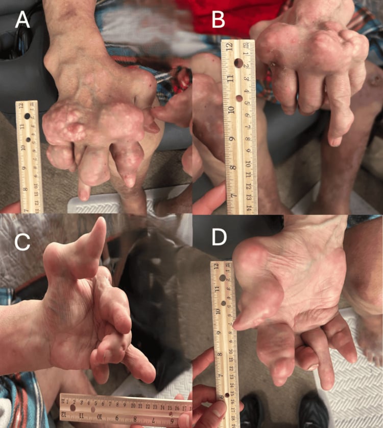 Four clinical views (A-D) of severe tophaceous gout of the hand, with a ruler for scale