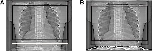 CT chest localiser scout radiographs demonstrating scan length boundary optimization