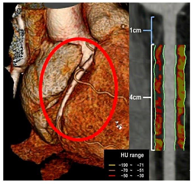 3D CT volume-rendered reconstruction detailing Hounsfield unit color map scale