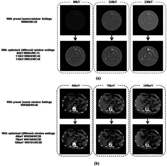 Axial CT windowing comparison of preset vs optimized window level and width settings