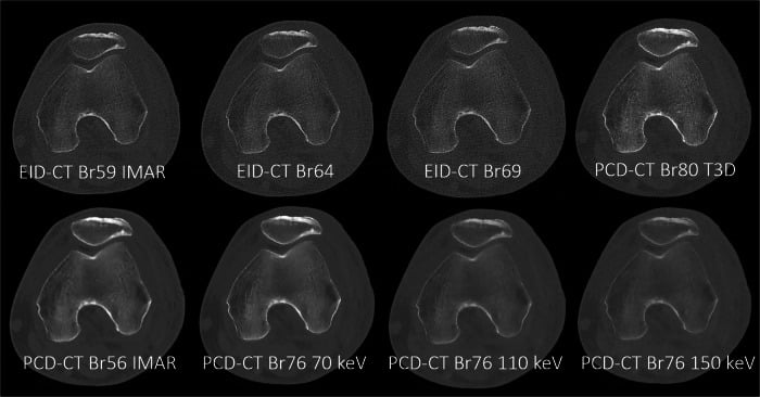 Axial CT slices of orthopedic implant demonstrating metal streak artifacts and iMAR reduction