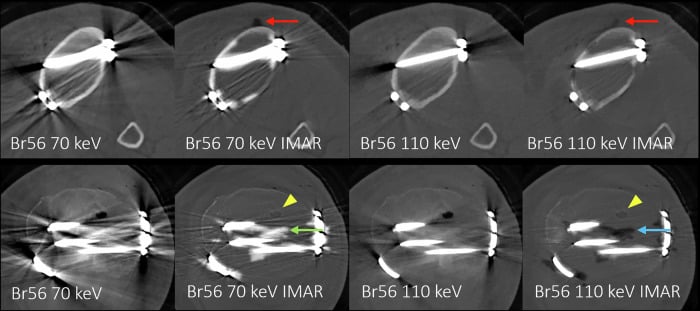 Axial CT slices demonstrating metal streak artifact reduction across monoenergetic keV levels