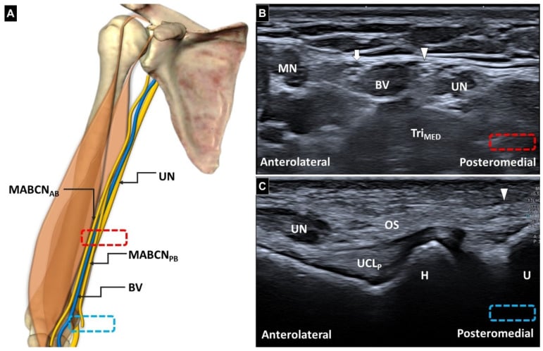 Diagram of the upper limb and two ultrasound images labelling the ulnar nerve and the anterior and posterior branches of the medial antebrachial cutaneous nerve