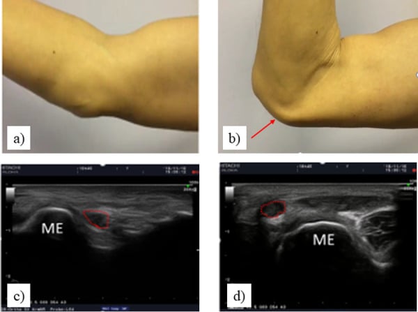 Medial elbow in extension and flexion with paired ultrasound images of the ulnar nerve beside the medial epicondyle
