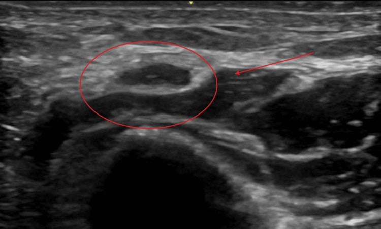 Ultrasound image with the ulnar nerve circled in red at the cubital tunnel