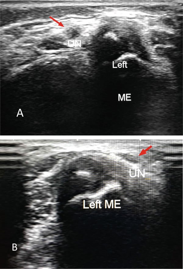 Two ultrasound images of a left elbow showing the ulnar nerve in different positions relative to the medial epicondyle