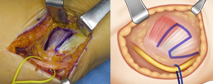 Operative photograph and drawing of a Z-shaped outline marked on the flexor-pronator fascia beside a looped ulnar nerve