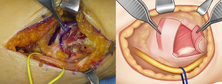 Operative photograph and drawing of raised fascial and musculofascial flaps beside a looped ulnar nerve