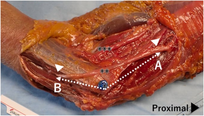 Cadaveric anterior transposition with dotted lines A and B running proximally and distally from a pin