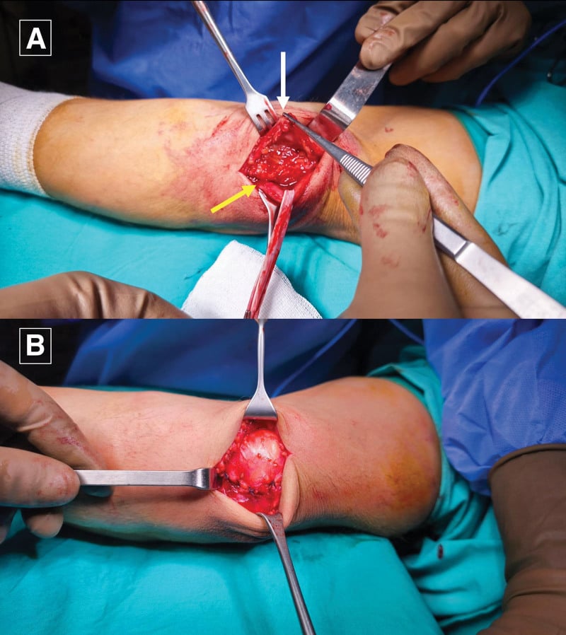 Open subcutaneous anterior ulnar nerve transposition