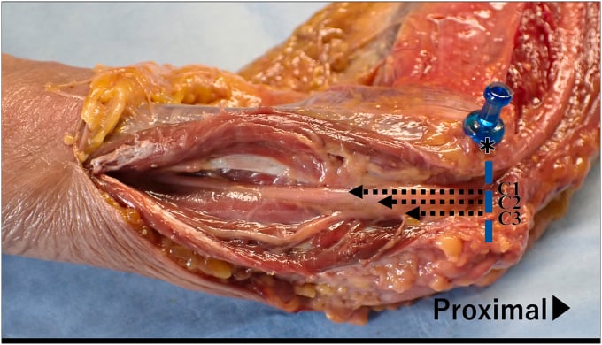 Cadaveric positions of distal ulnar motor branches, labelled C1 to C3, relative to a pin at the medial epicondyle
