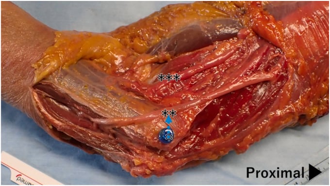 Cadaveric anterior ulnar-nerve transposition with the pin and asterisk labels and no measurement overlay