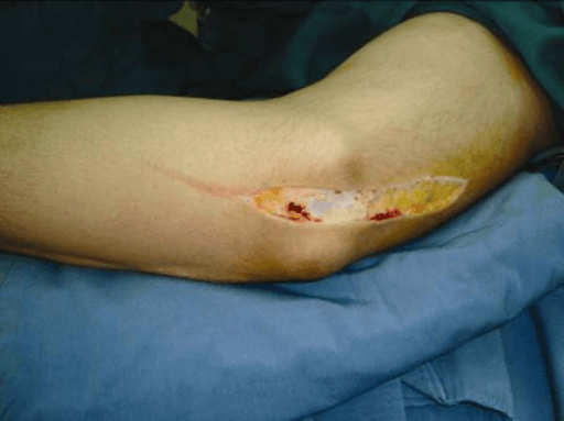 Longitudinal skin incision over the medial elbow for cubital tunnel decompression