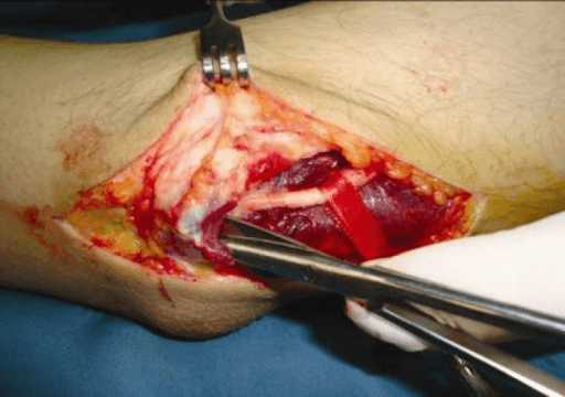 Intraoperative photograph of ulnar nerve dissection at the elbow
