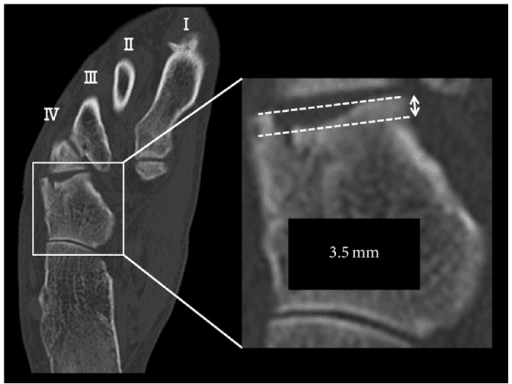 Axial CT of the foot with metatarsals I-IV labelled and a magnified inset showing a 3.5mm depression of the cuboid-fourth metatarsal joint surface
